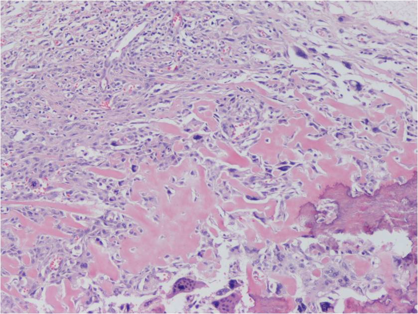 extraskeletal-osteosarcoma-soft-tissue-osteosarcoma